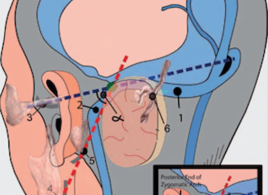 preoperative-exposure-of-sigmoid-sinus-trajectory-in-posterolateral-cranial-base-approaches-using-a-new-landmark-through-a-neurosurgical-perspective
